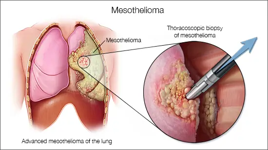 Understanding Mesothelioma: What You Need to Know